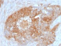 FFPE human ovarian carcinoma sections stained with 100 ul anti-Fascin-1 (clone FSCN1/417) at 1:400. HIER epitope retrieval prior to staining was performed in 10mM Citrate, pH 6.0.